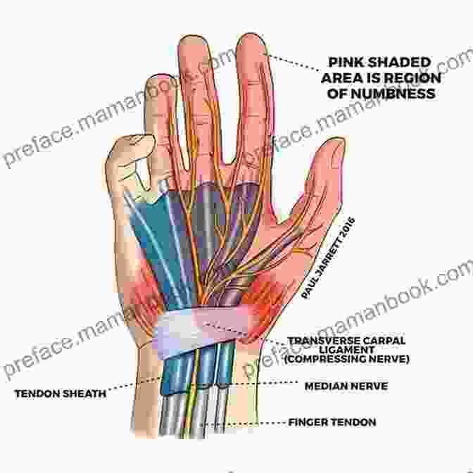 Carpal Tunnel Syndrome Chart Carpal Tunnel Syndrome E Chart: Full Illustrated