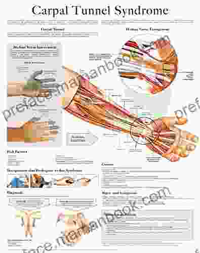 Carpal Tunnel Syndrome E Chart: Full Illustrated